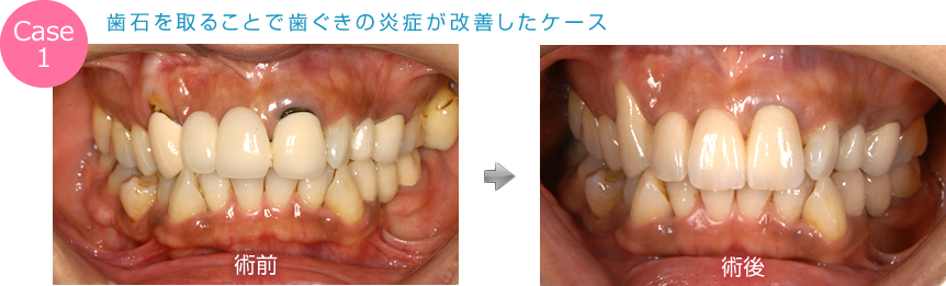 歯石を取ることで歯ぐきの炎症が改善したケース