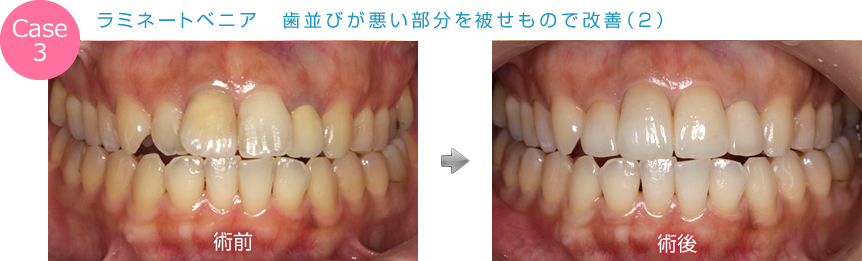 ラミネートベニア　歯並びが悪い部分を被せもので改善（2）