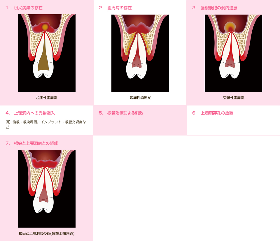 歯性止顎洞炎の原因